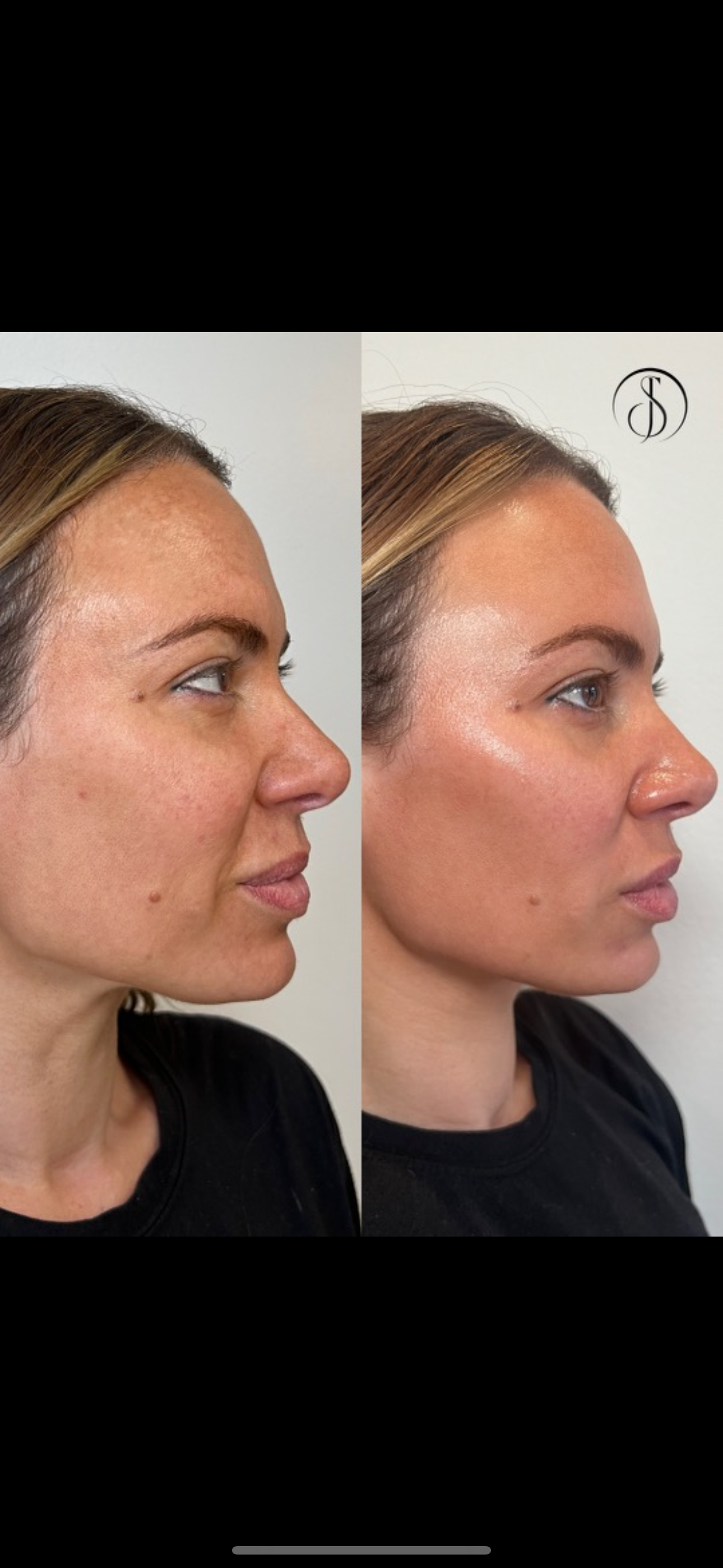 Before and after photos of a woman's profile; showing skin discoloration reduction after a procedure.