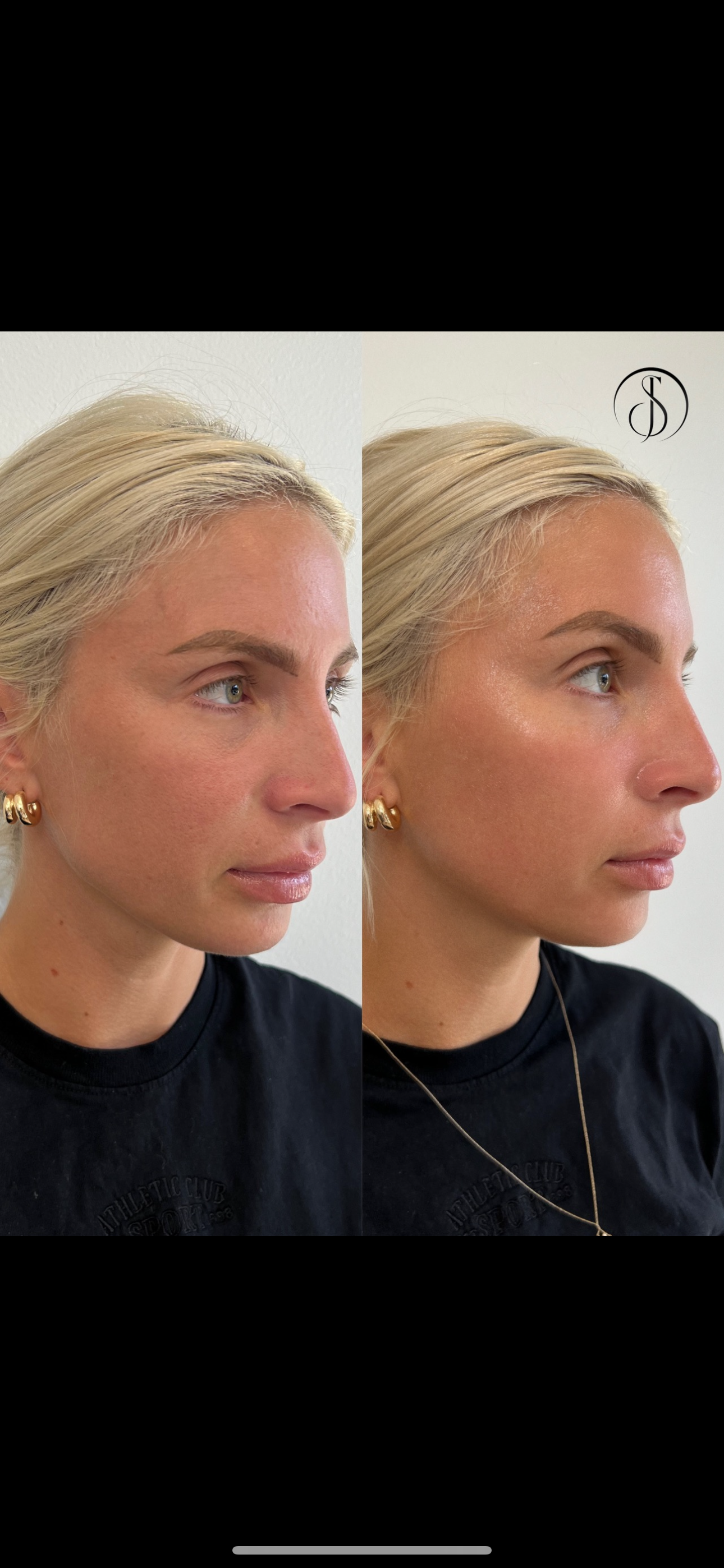 Side-by-side portrait of a woman before and after a cosmetic procedure on her nose, possibly rhinoplasty.