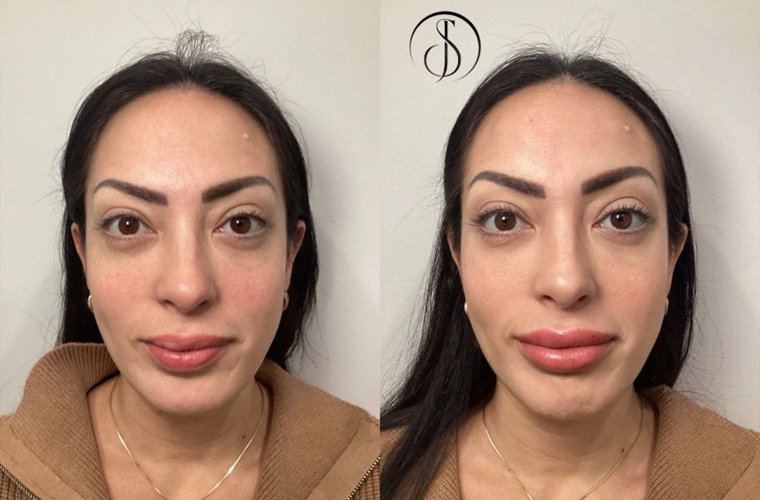 Side-by-side photos of a woman's face before and after lip filler. Lips appear fuller in the right image.