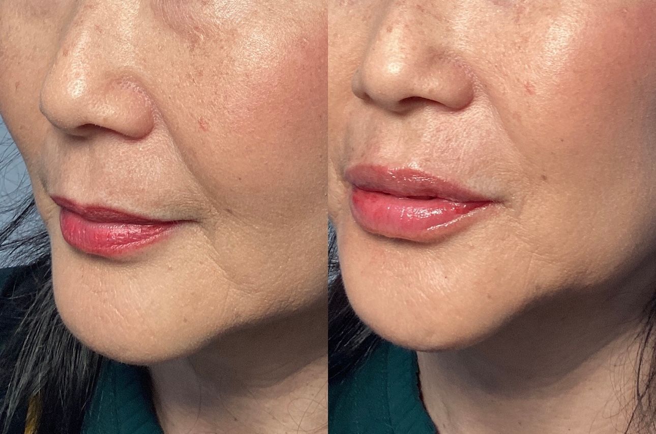 Side-by-side photos of a woman's face: left shows wrinkles, right shows smoother skin after treatment.