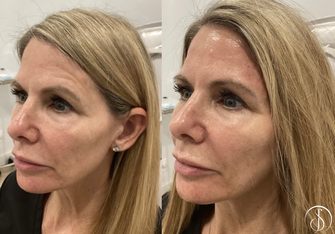 Two side-profile photos of a woman; the left with less smooth skin, the right after a skin treatment.