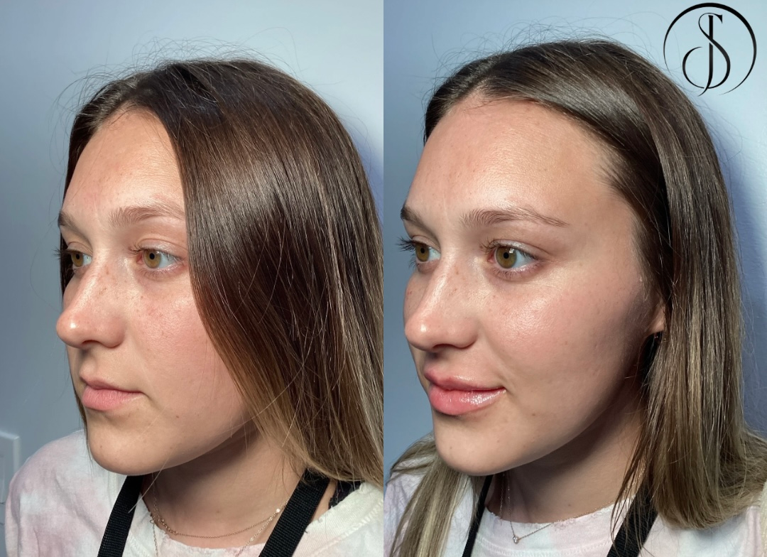 Before-and-after photo of a woman's face. Left: Profile view; Right: Profile with fuller lips and nose.