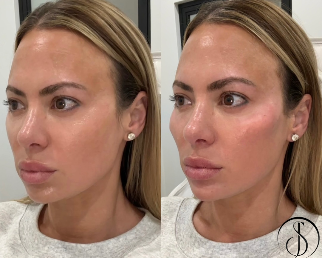 Side-by-side photos show a woman’s face before and after cosmetic injections. The 