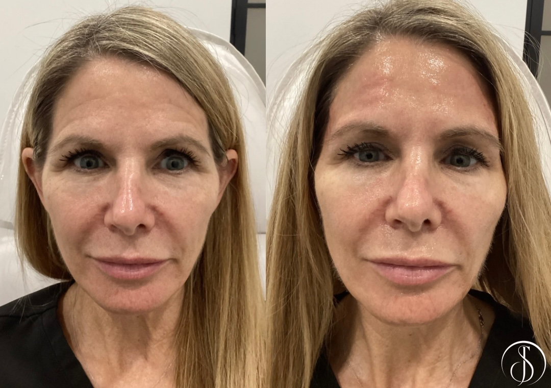 Side-by-side comparison of a woman's face before and after cosmetic injections