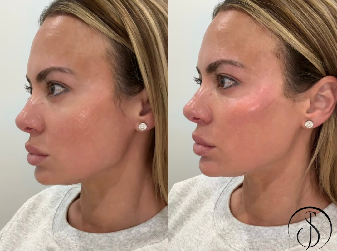 Woman's face before and after cosmetic cheek filler injections. Side profiles show cheek augmentation with slight redness.