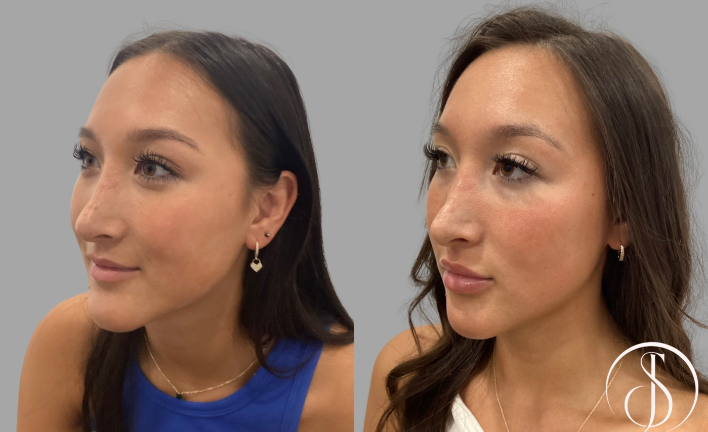 Before and after photos of a woman's nose; the 
