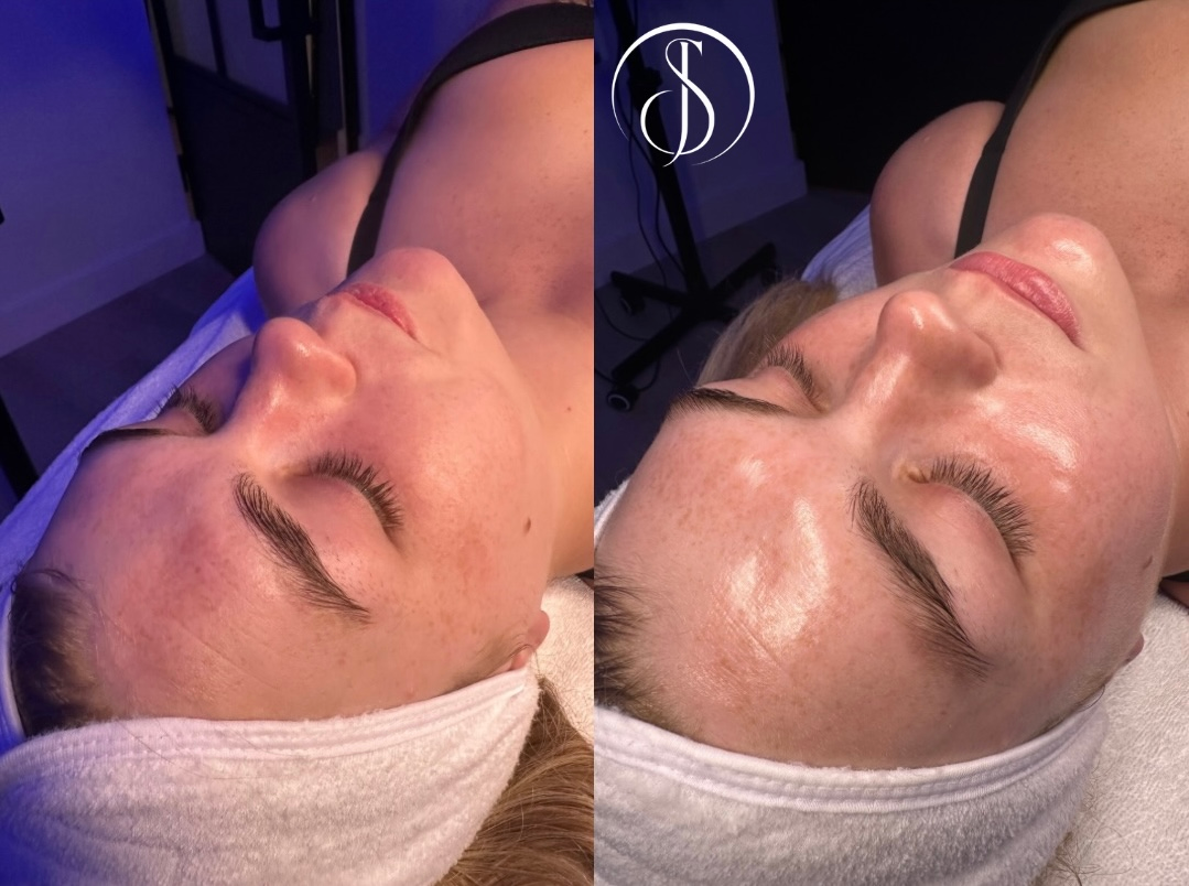 Before and after facial treatment, woman lying down. Face shows visible difference in skin texture and color.