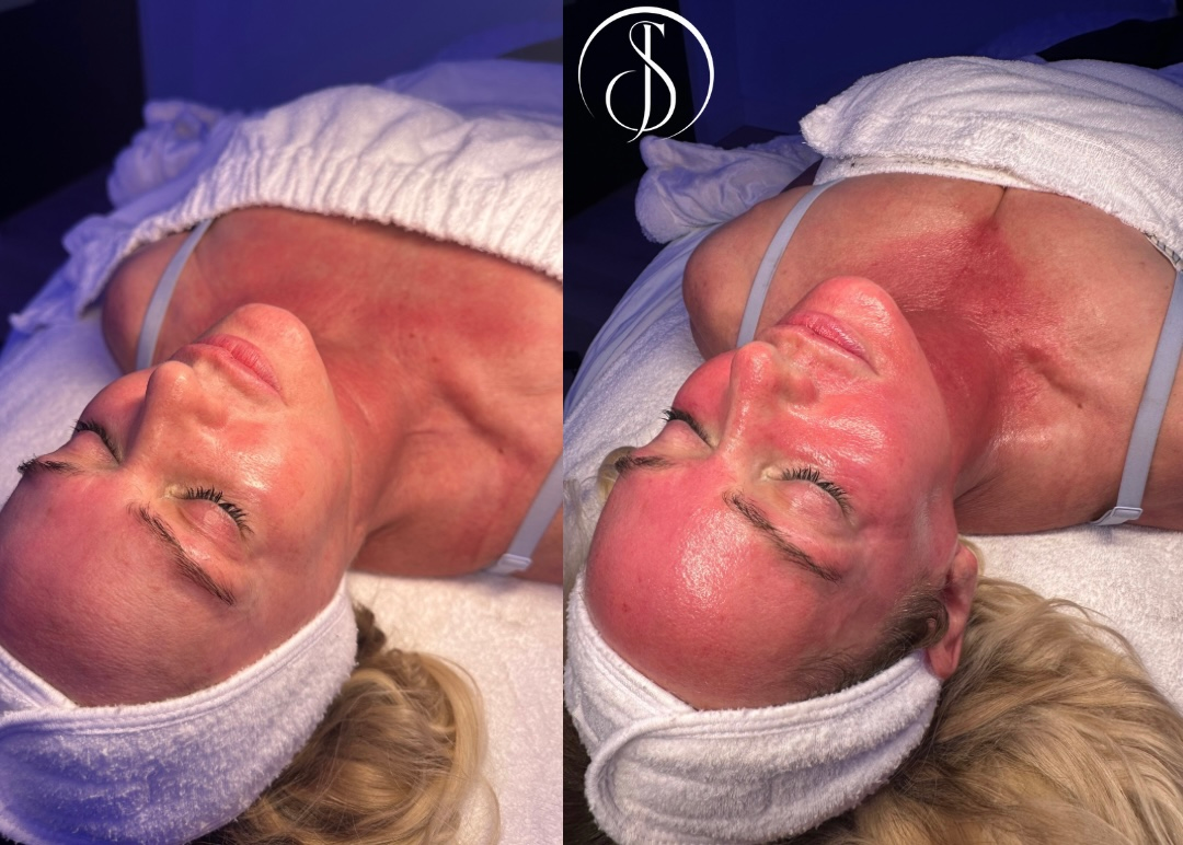Woman with flushed face and neck, likely after a skincare treatment, lying down.