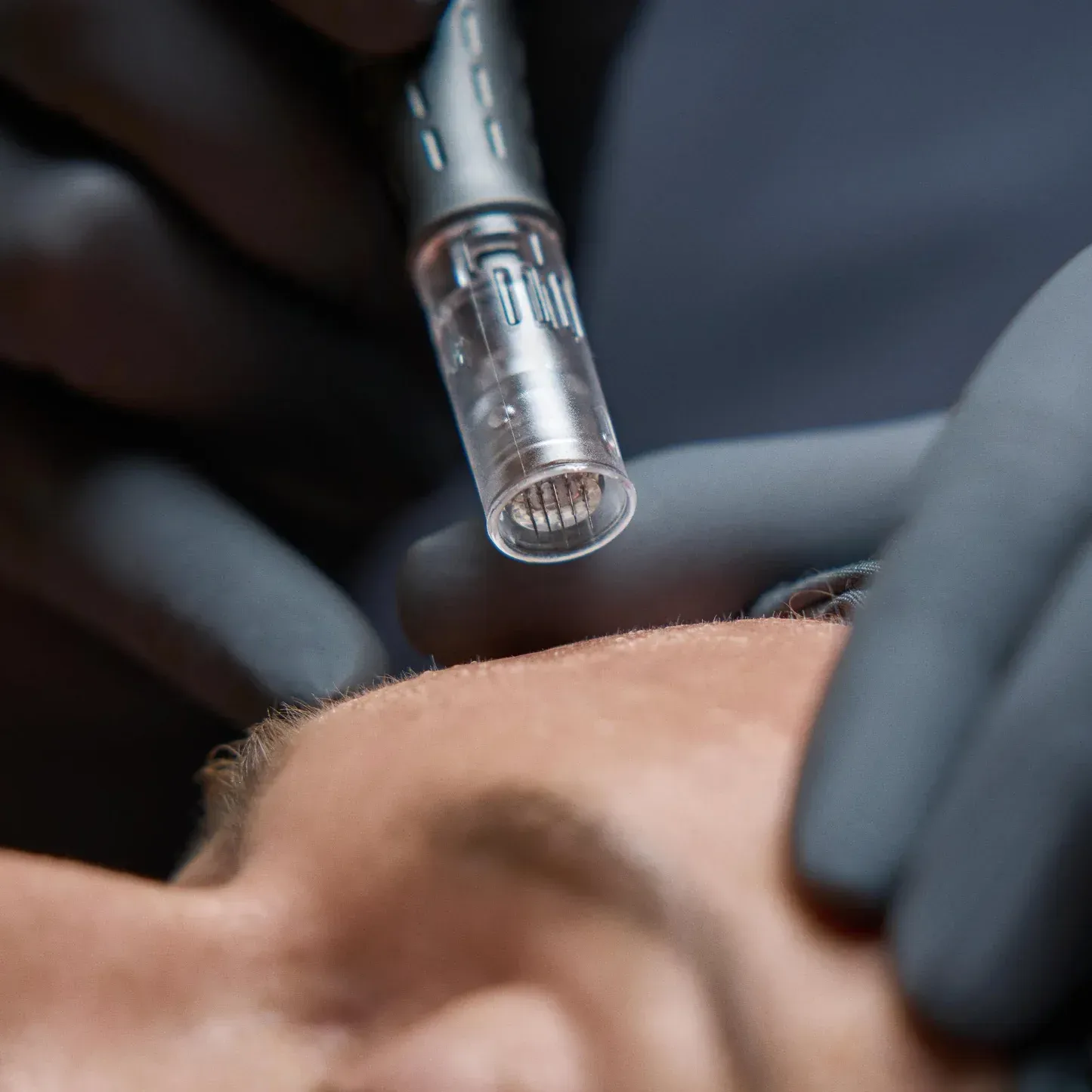 A woman receiving a microneedling treatment to her forehead, in a spa setting.