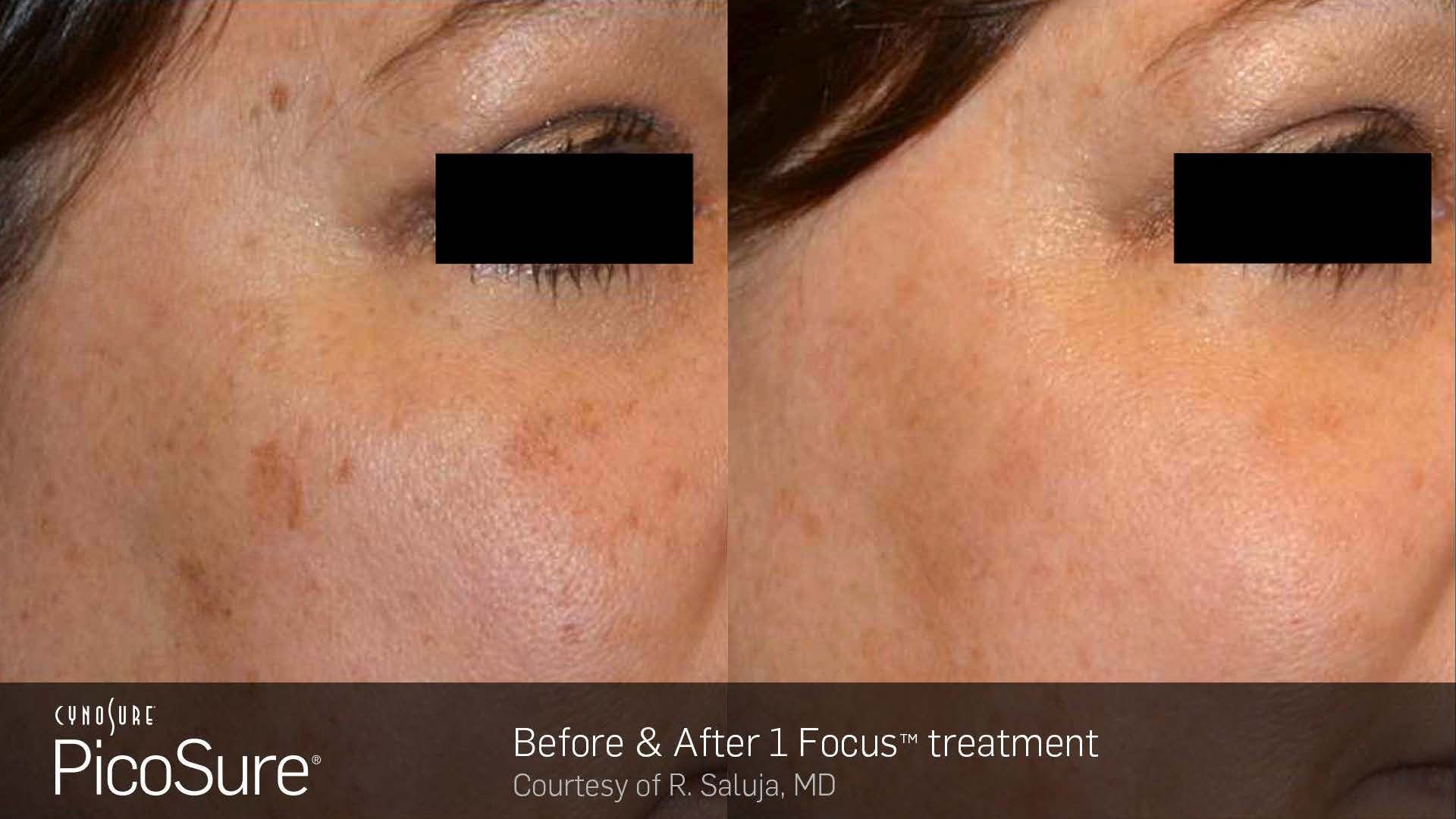 A woman 's face is shown before and after a picosure treatment.
