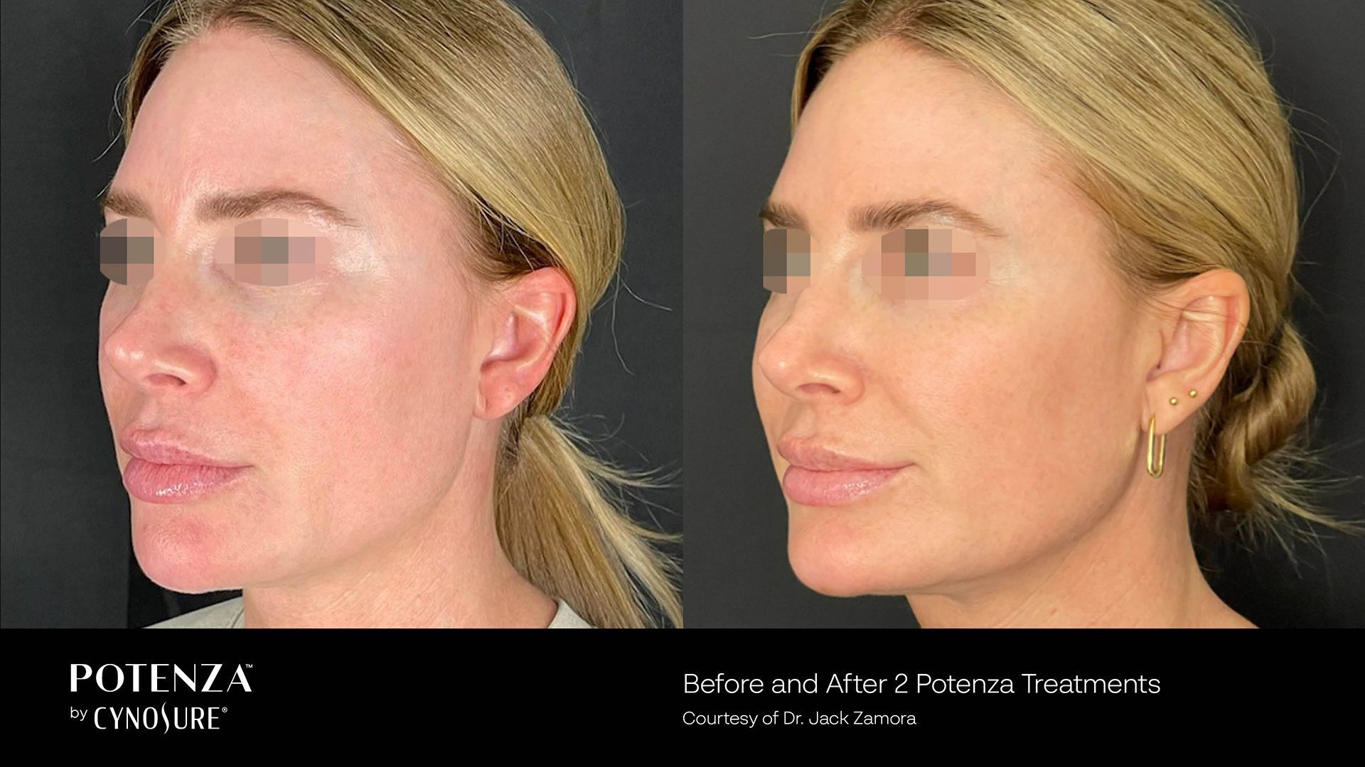 A before and after photo of a woman 's face.