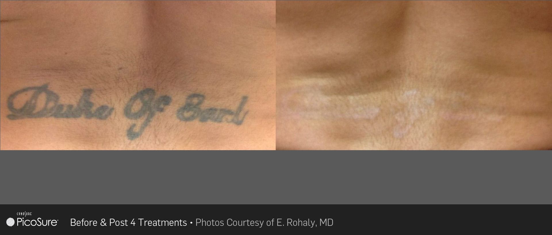 A before and after photo of a tattoo on a person 's chest.