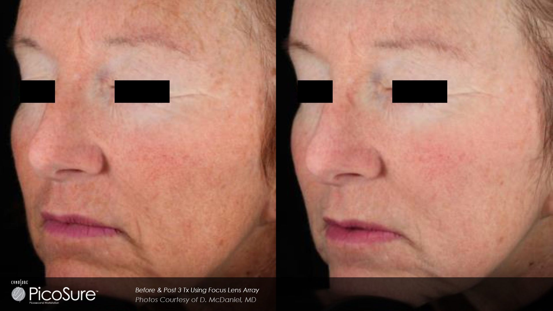 A before and after photo of a woman 's face