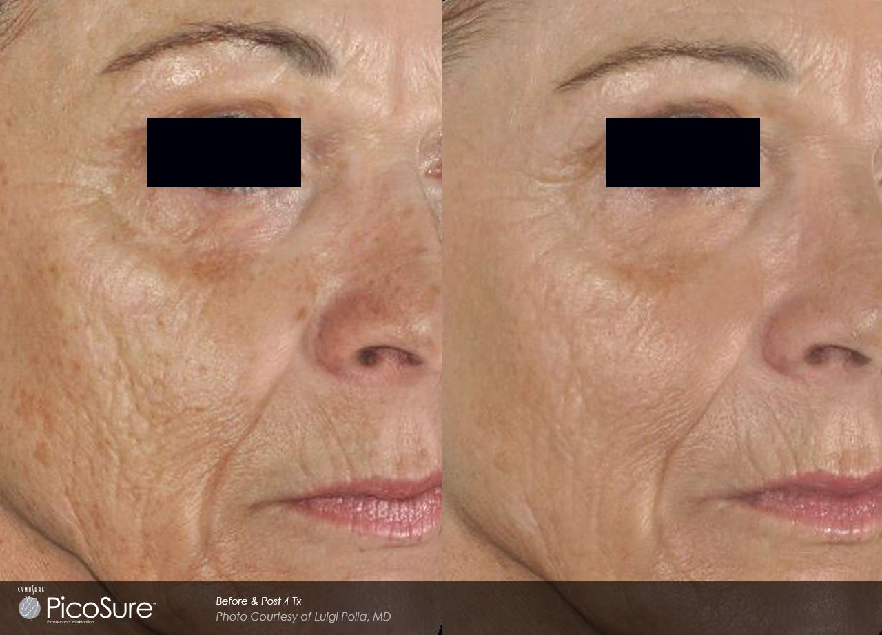 A before and after photo of a woman 's face.