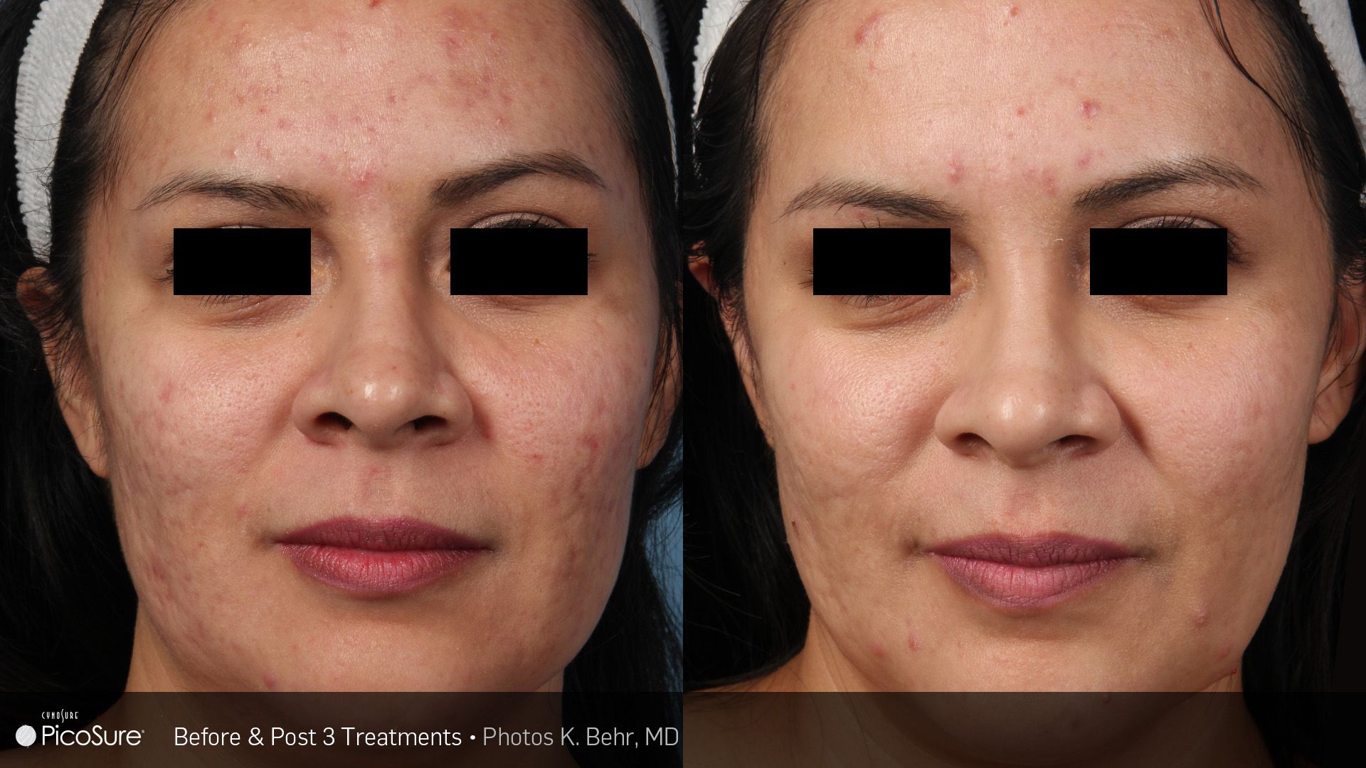 A before and after photo of a woman 's face with acne.