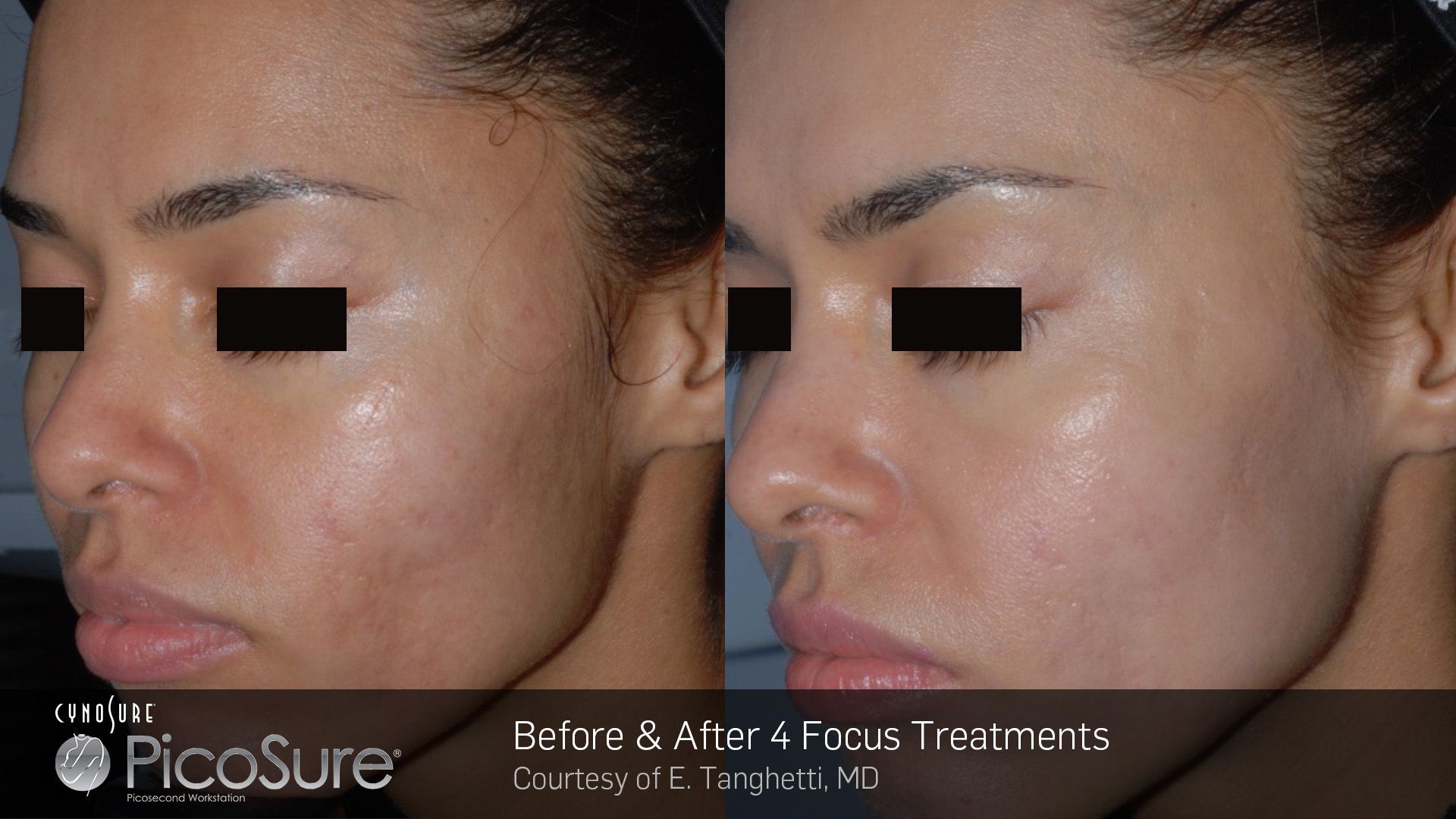 A woman 's face is shown before and after picosure treatments