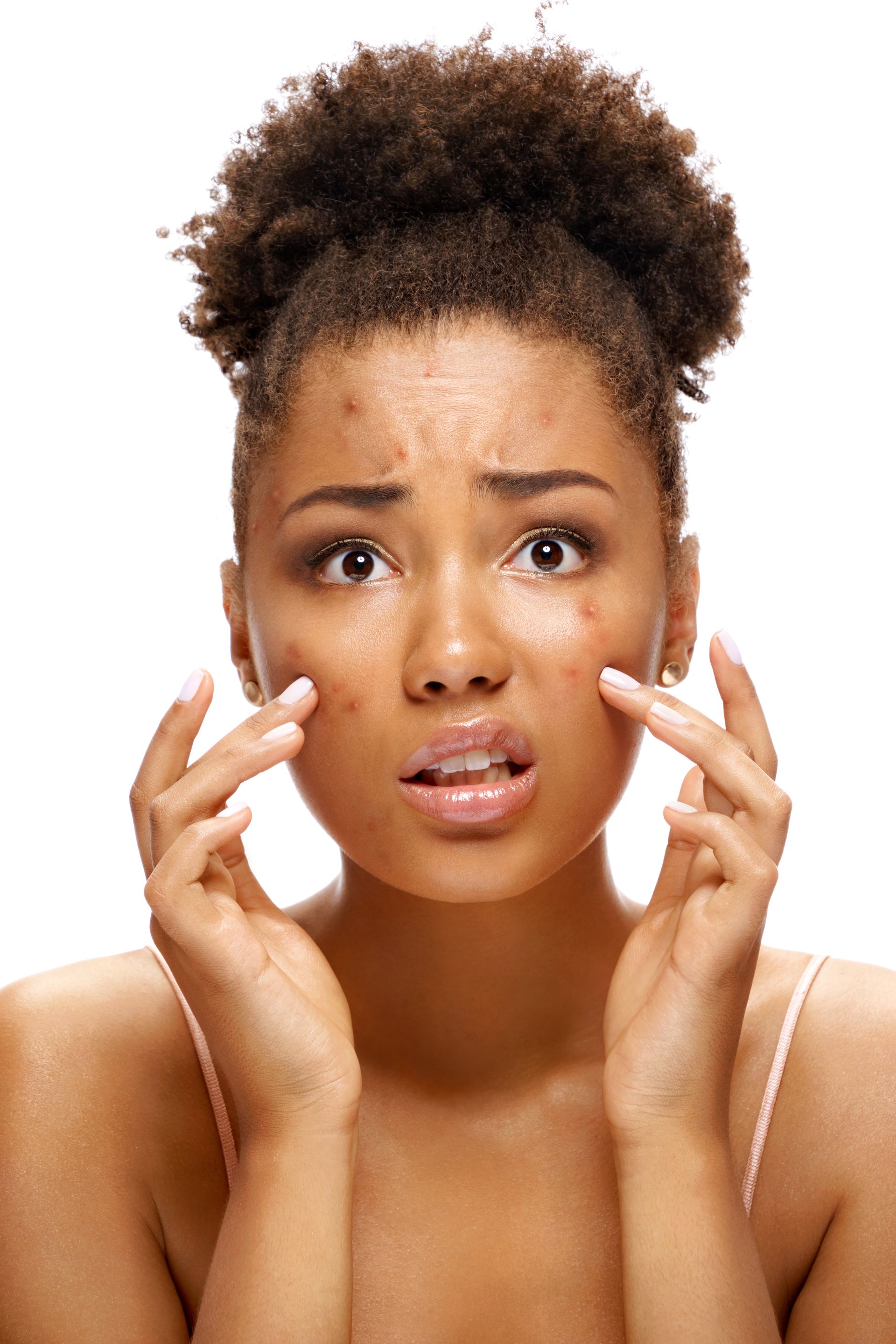 A woman with acne on her face is looking at her face.