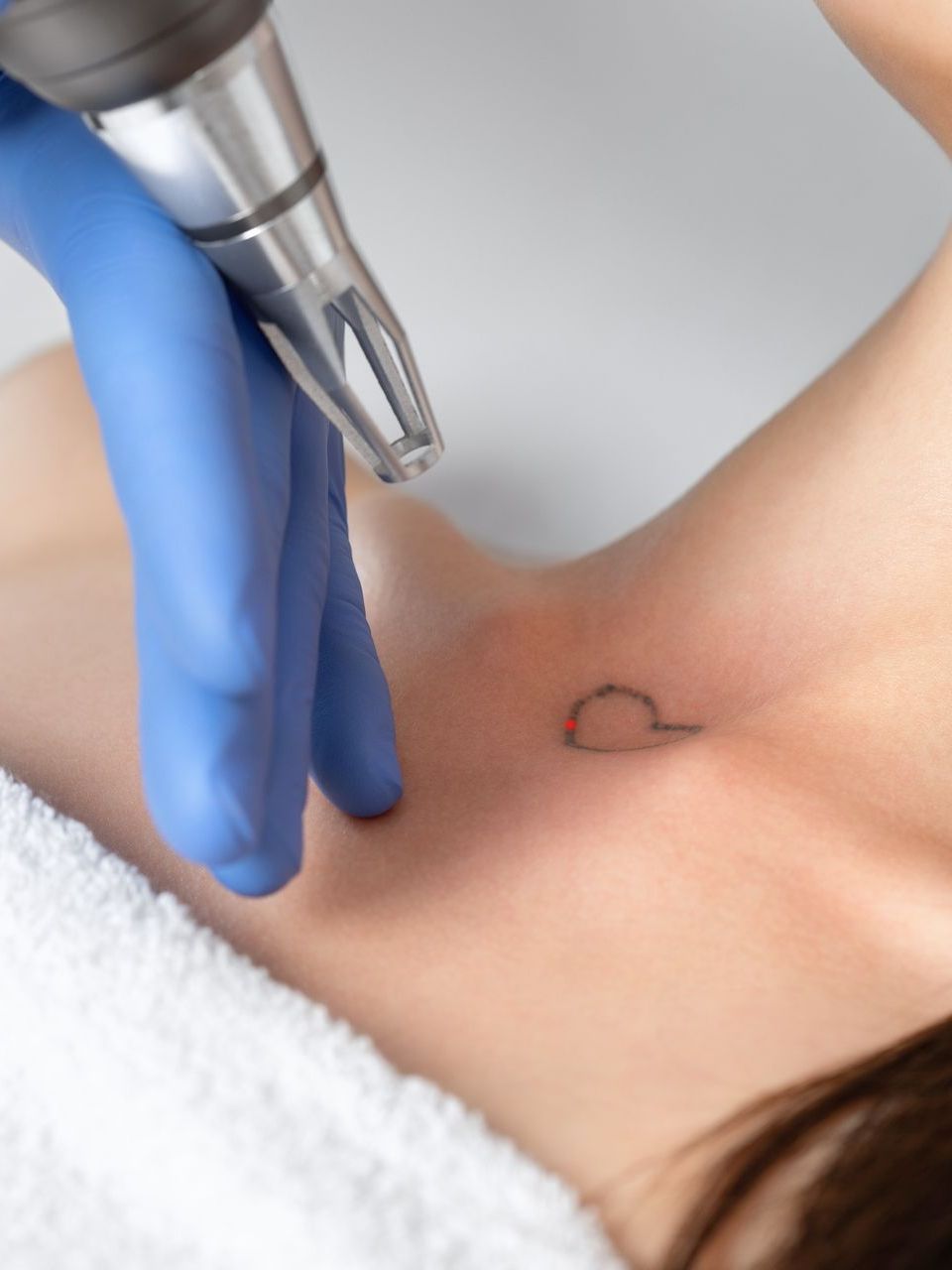 tattoo laser removal