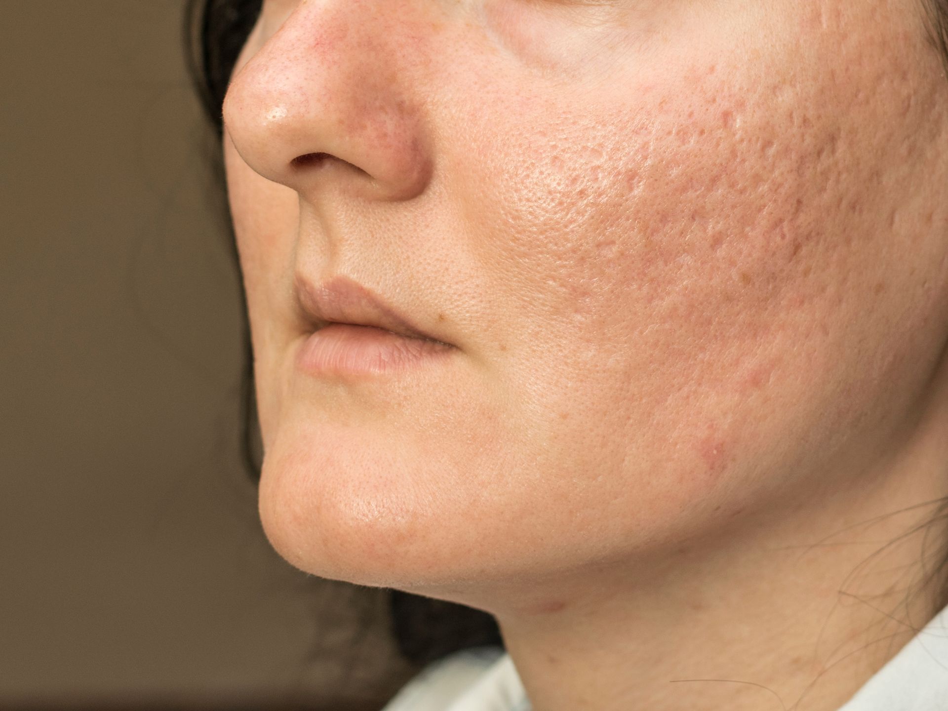 A close up of a woman 's face with acne on it.