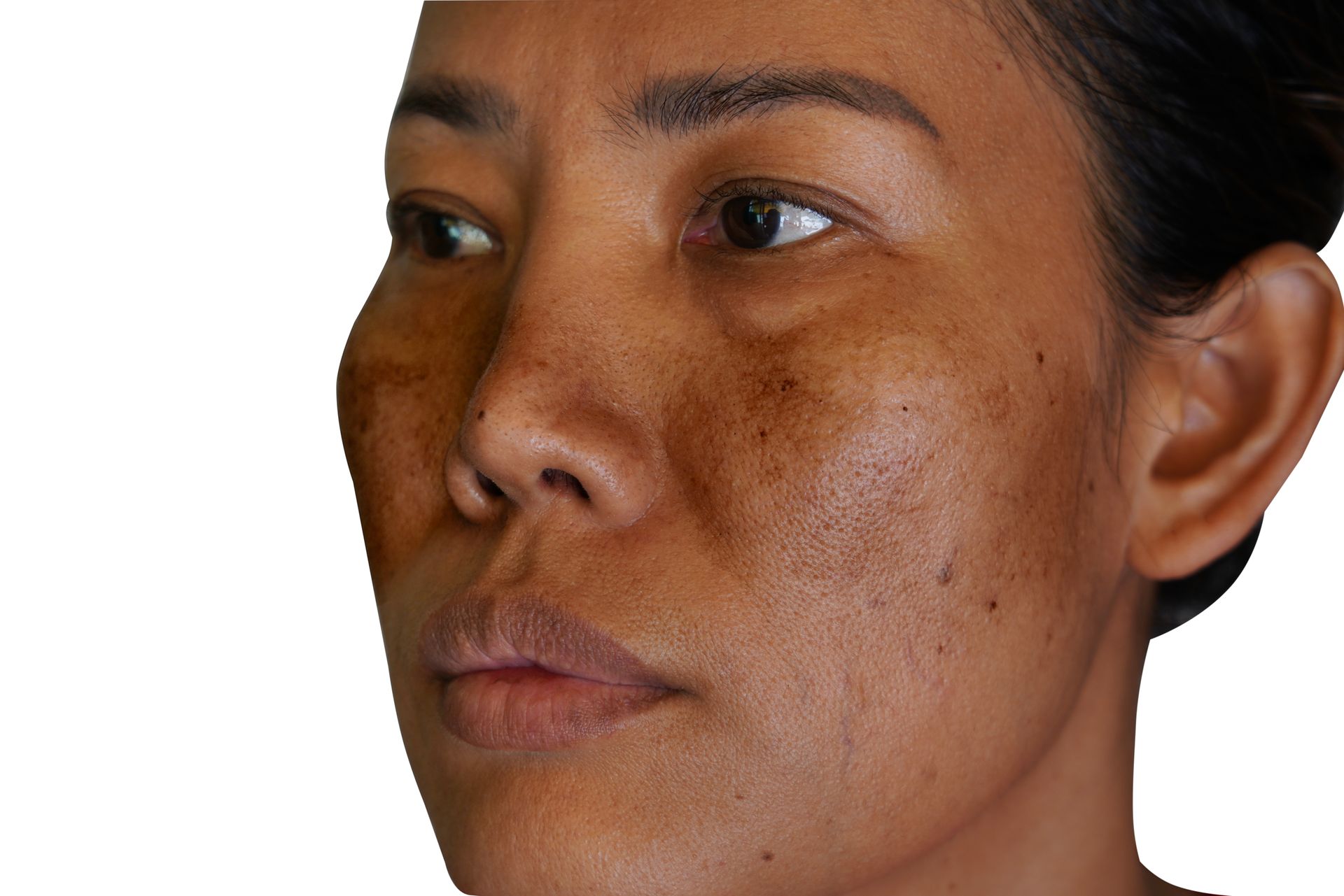 A close up of a woman 's face with brown spots on it.