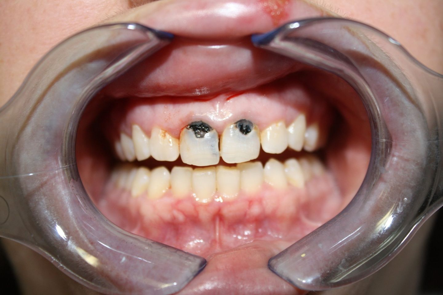 Before Cosmetics Dentistry — Florence, AL — Johnson & Mahan Dental Care