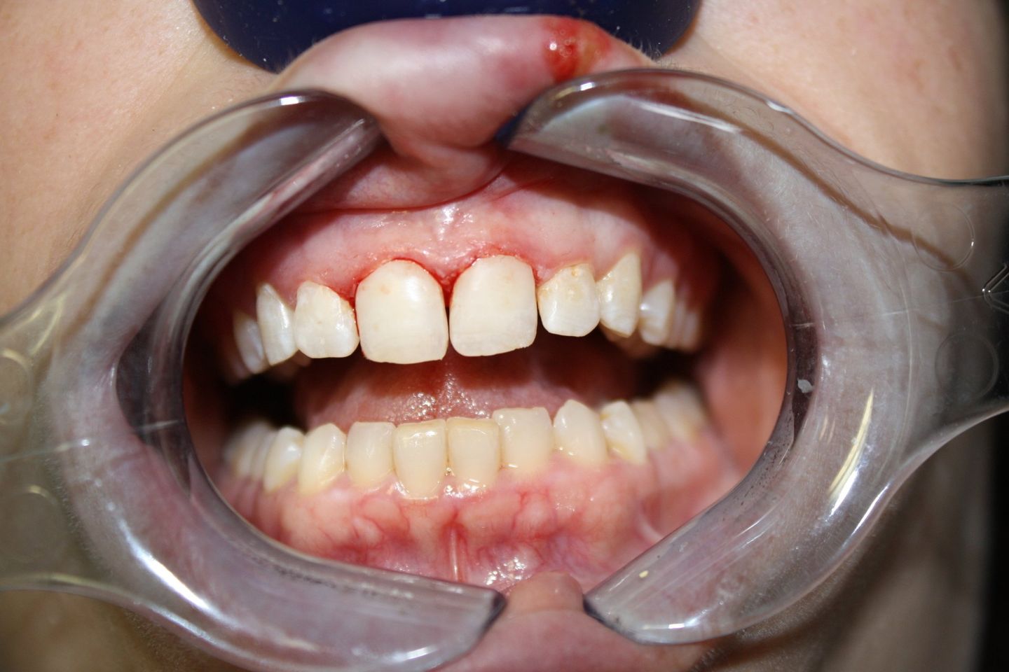 After Cosmetics Dentistry — Florence, AL — Johnson & Mahan Dental Care