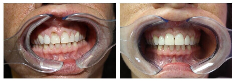 Teeth Restoration — Florence, AL — Johnson & Mahan Dental Care