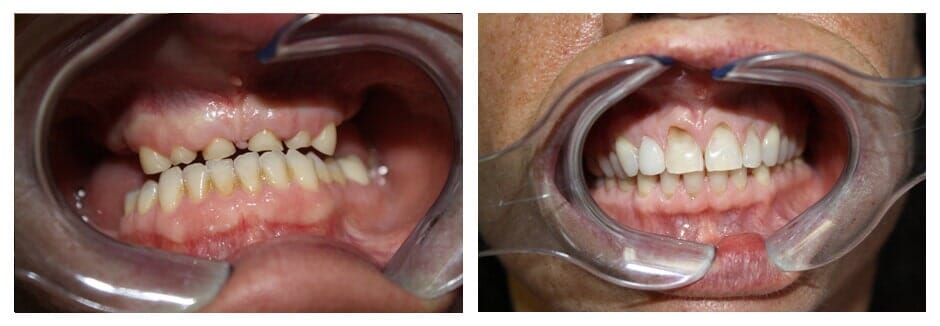 Removing Stain — Florence, AL — Johnson & Mahan Dental Care