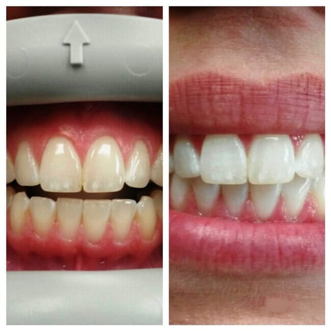 Whitening Teeth — Florence, AL — Johnson & Mahan Dental Care