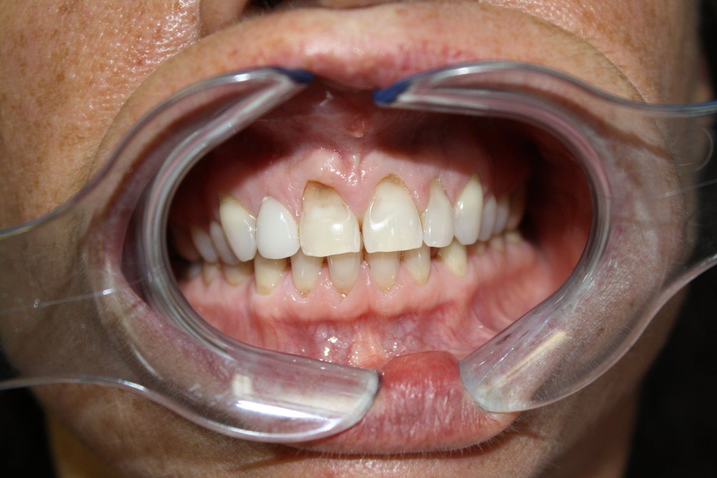 Before Teeth Filling — Florence, AL — Johnson & Mahan Dental Care