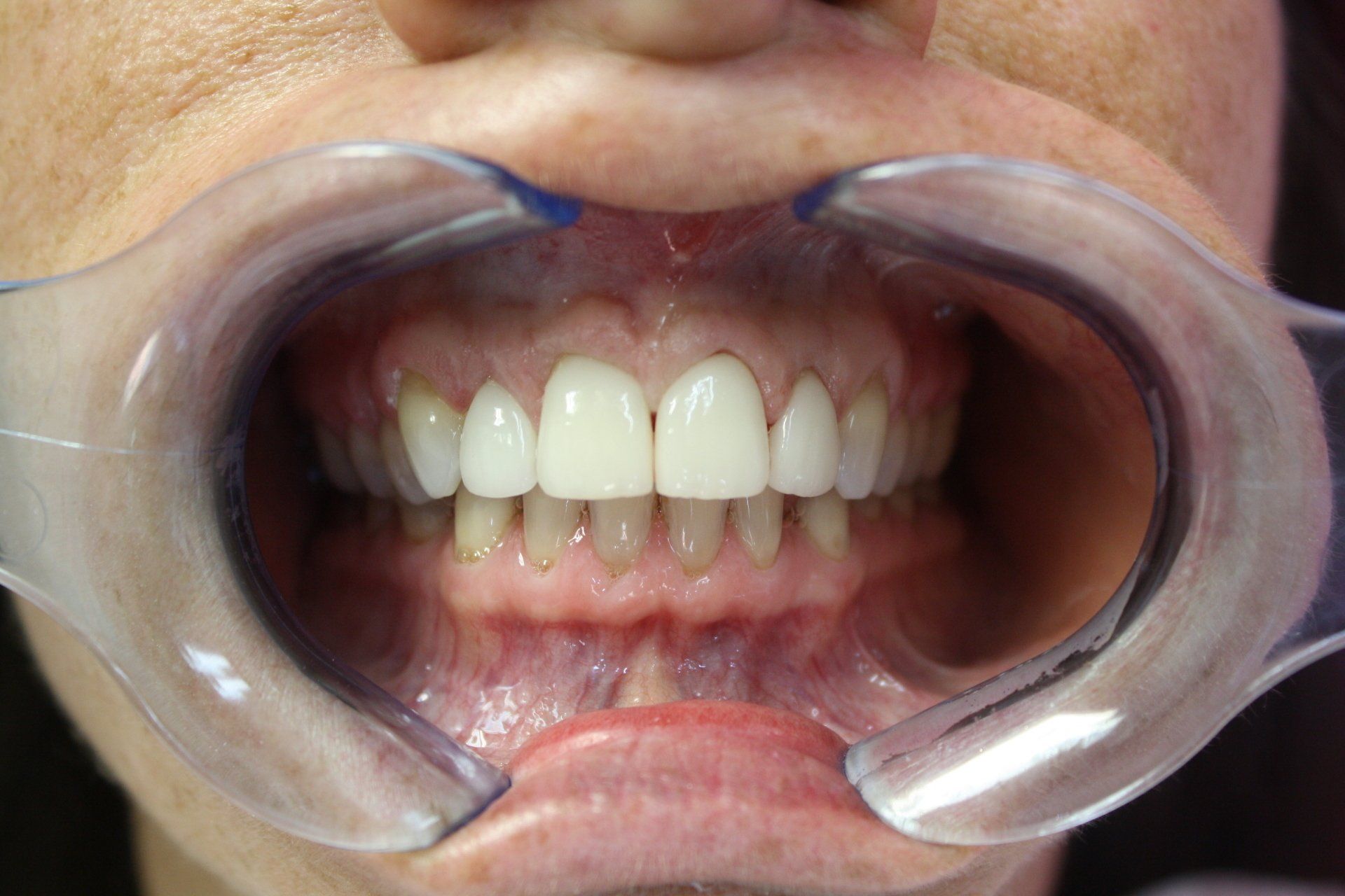 After Teeth Filling — Florence, AL — Johnson & Mahan Dental Care