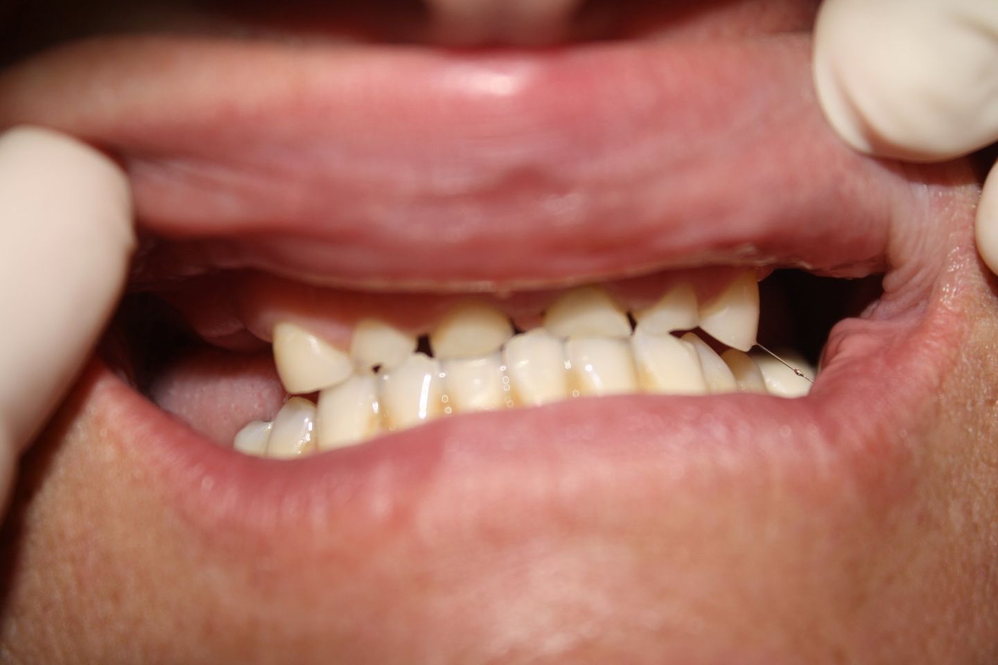 Before Dental Crowning — Florence, AL — Johnson & Mahan Dental Care