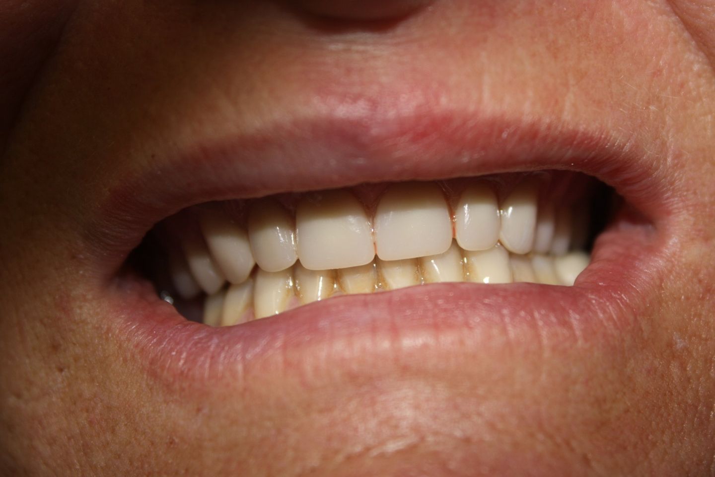 After Dental Crowning — Florence, AL — Johnson & Mahan Dental Care
