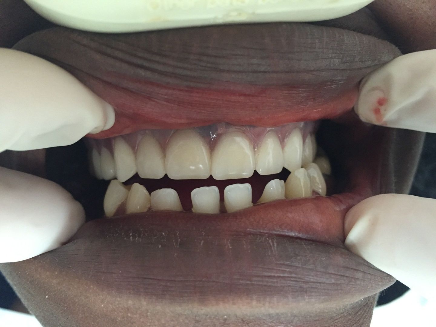 Dental Filling — Florence, AL — Johnson & Mahan Dental Care