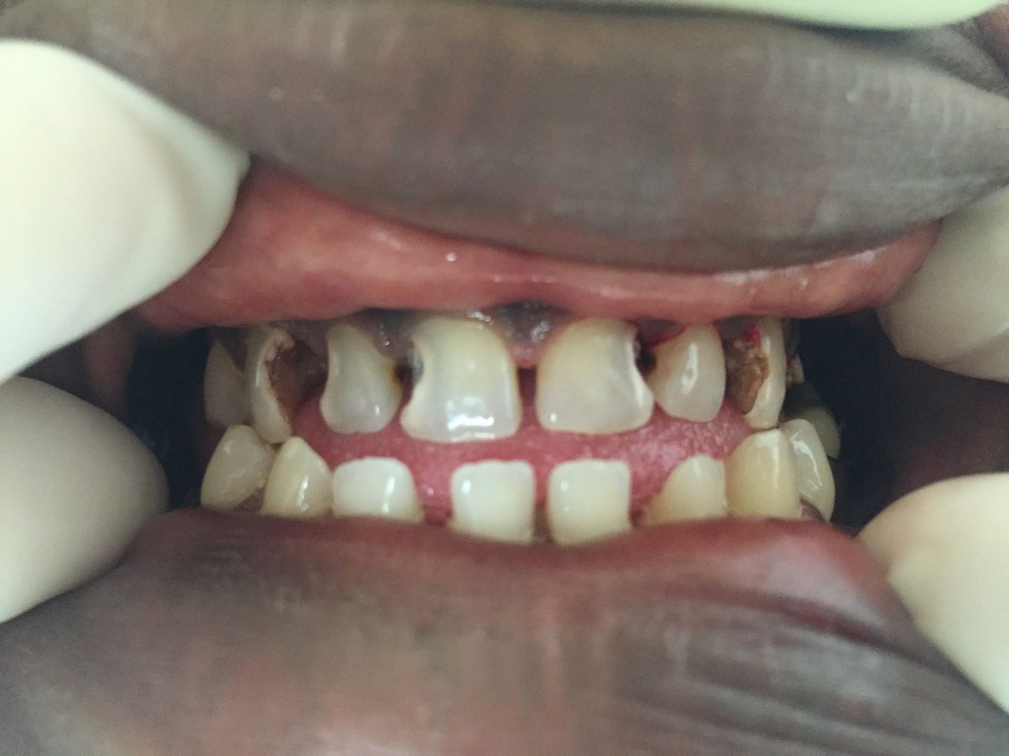 Before Dental Filling — Florence, AL — Johnson & Mahan Dental Care