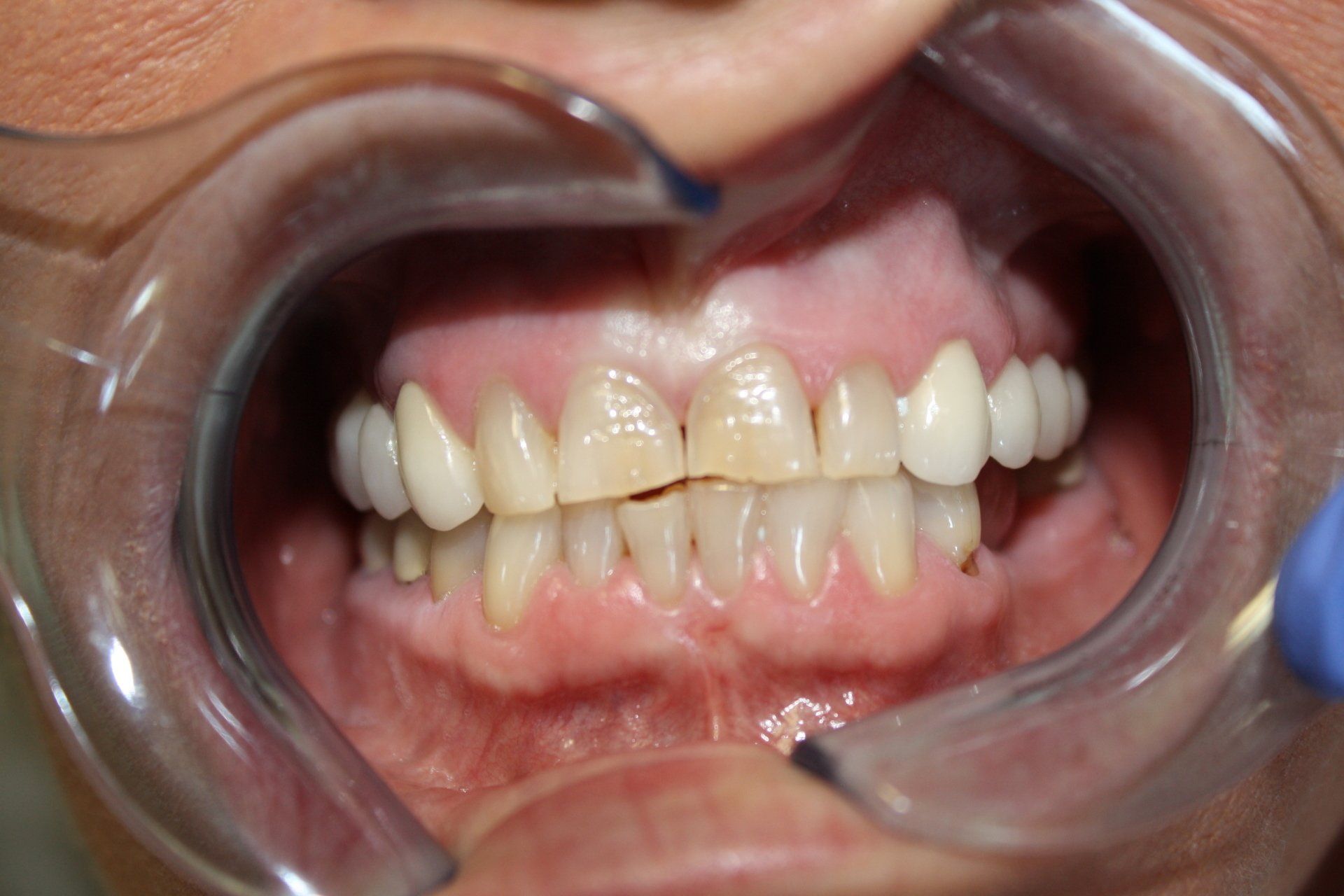Dental Retractor — Florence, AL — Johnson & Mahan Dental Care