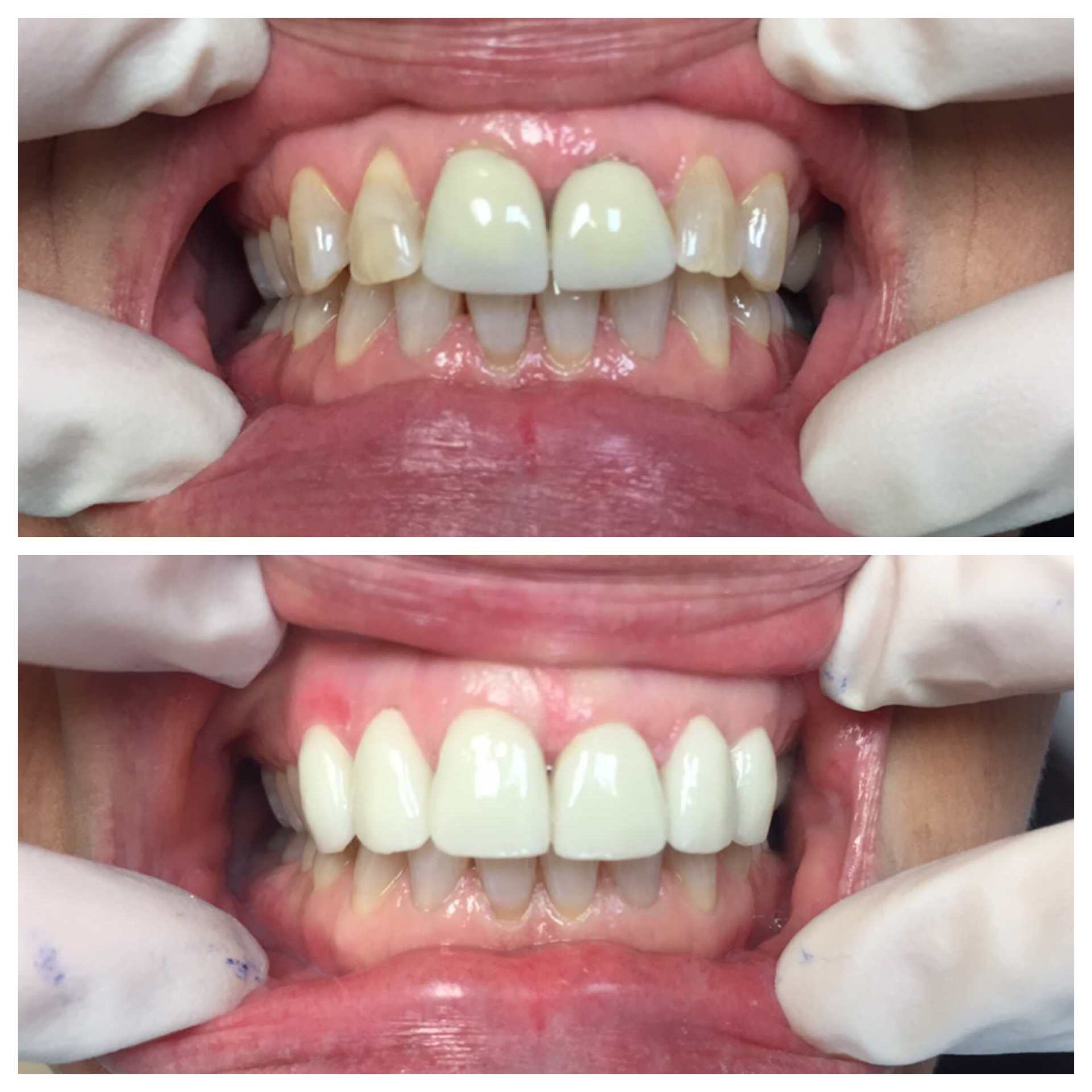 Before And After Teeth Whitening — Florence, AL — Johnson & Mahan Dental Care