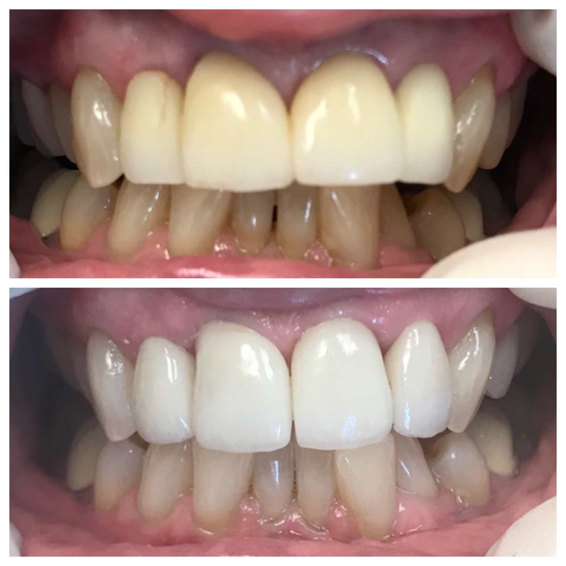 Before And After Teeth Cleaning — Florence, AL — Johnson & Mahan Dental Care