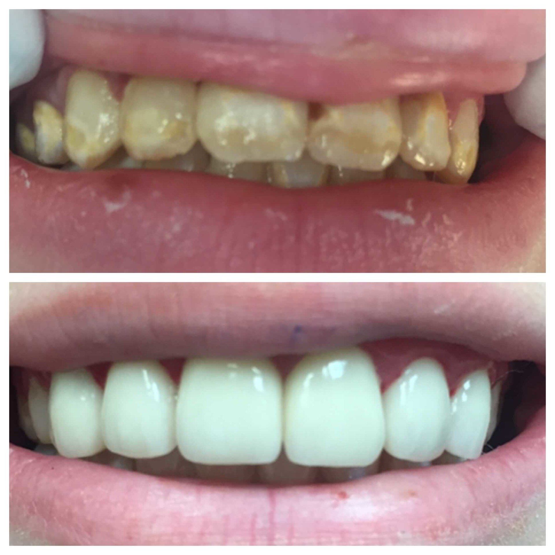 Result Of Teeth Whitening — Florence, AL — Johnson & Mahan Dental Care