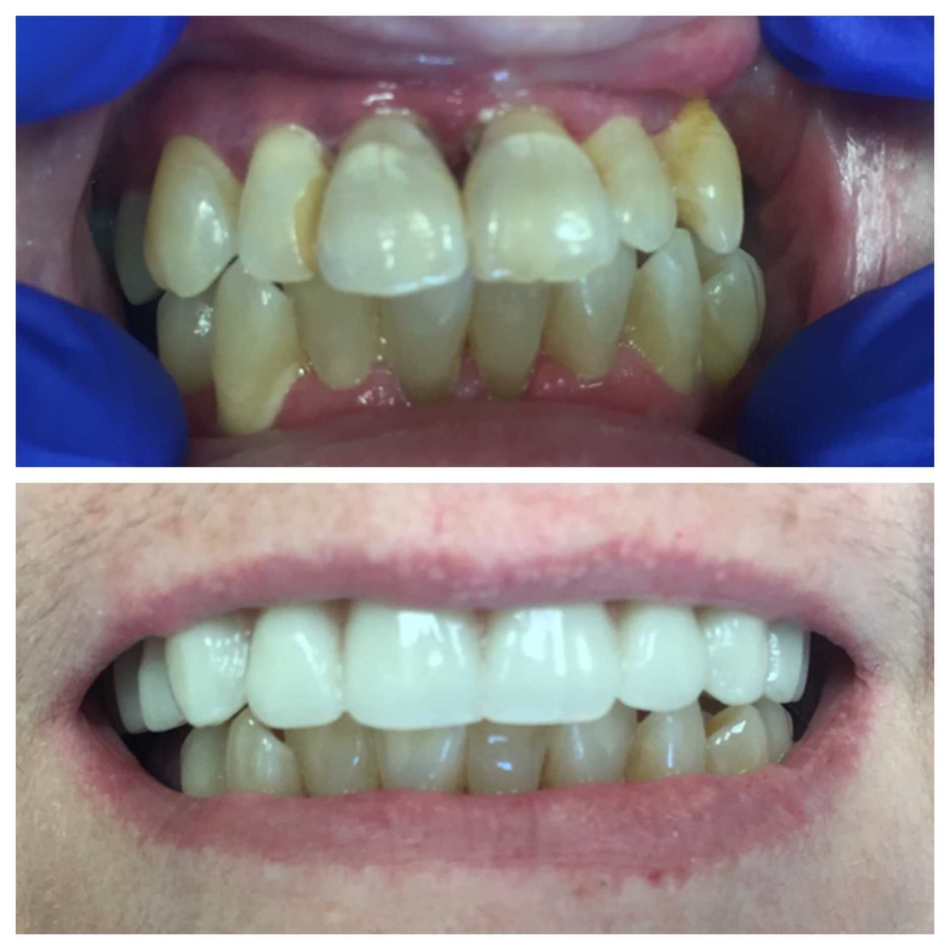 Teeth Whitening — Florence, AL — Johnson & Mahan Dental Care