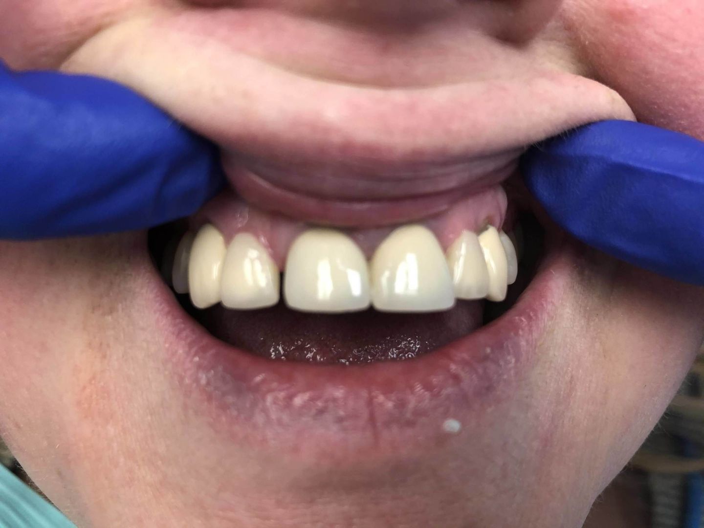 Before Dental Cleaning — Florence, AL — Johnson & Mahan Dental Care