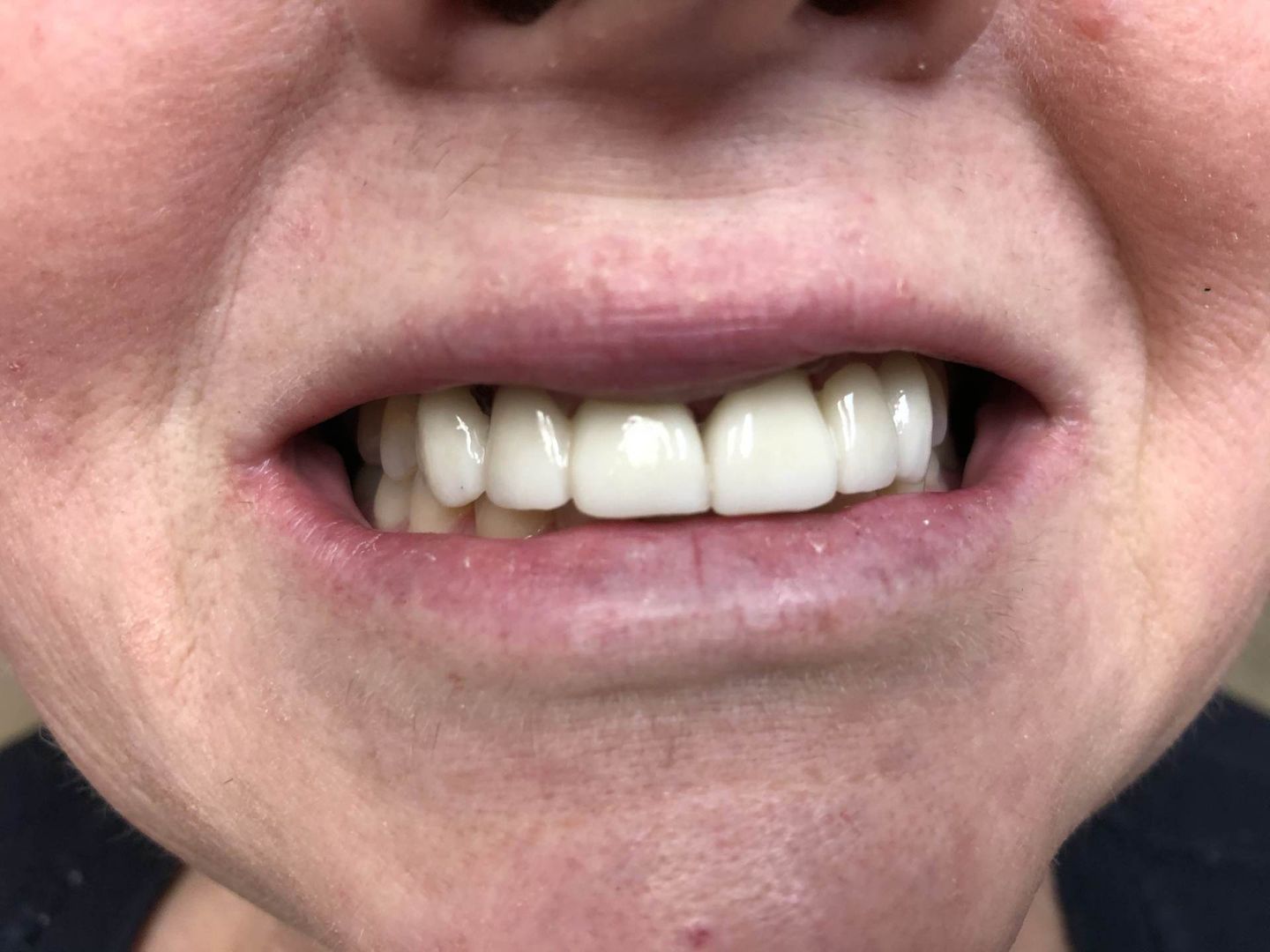 After Dental Cleaning — Florence, AL — Johnson & Mahan Dental Care