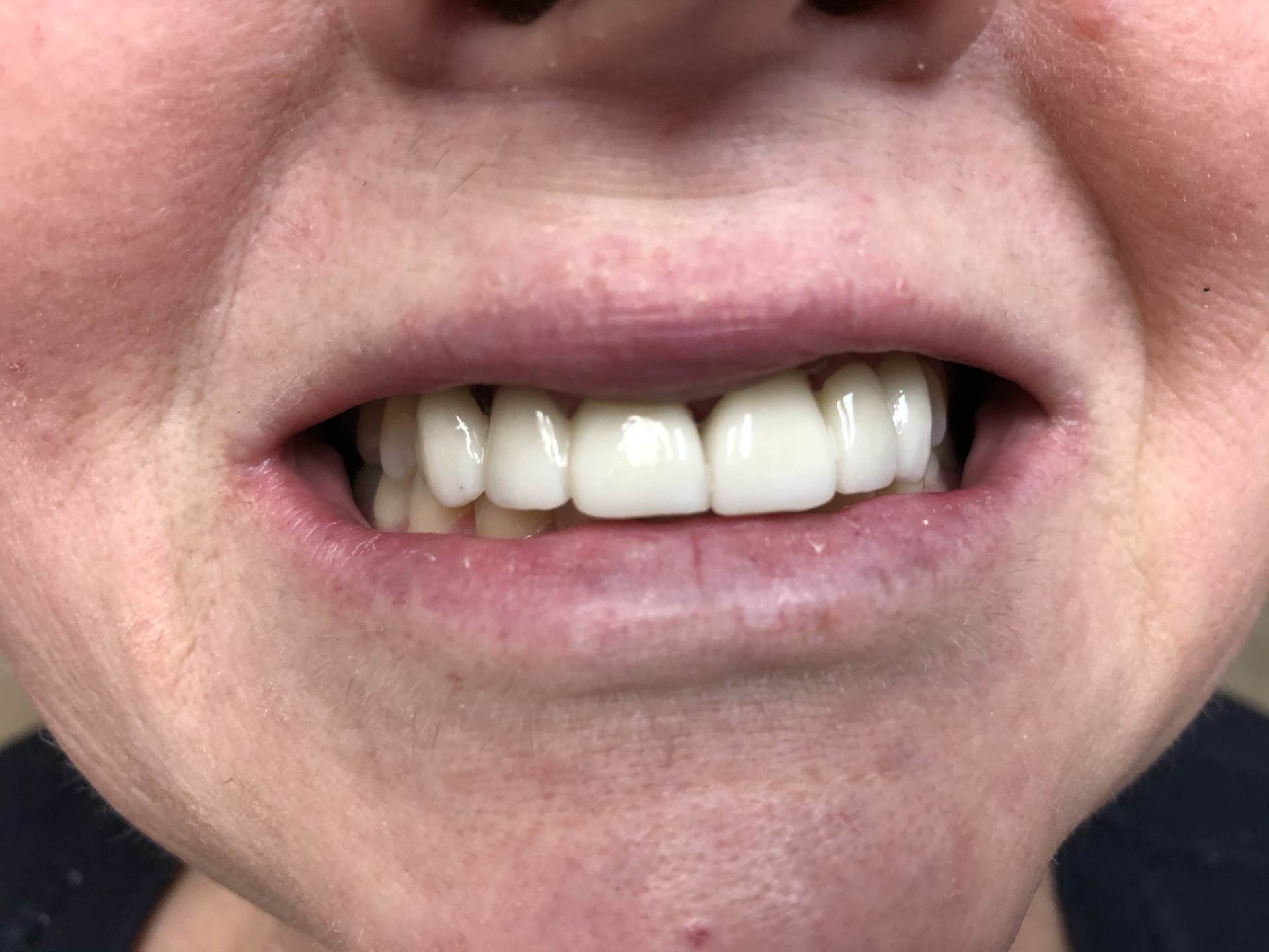 After Dental Cleaning — Florence, AL — Johnson & Mahan Dental Care