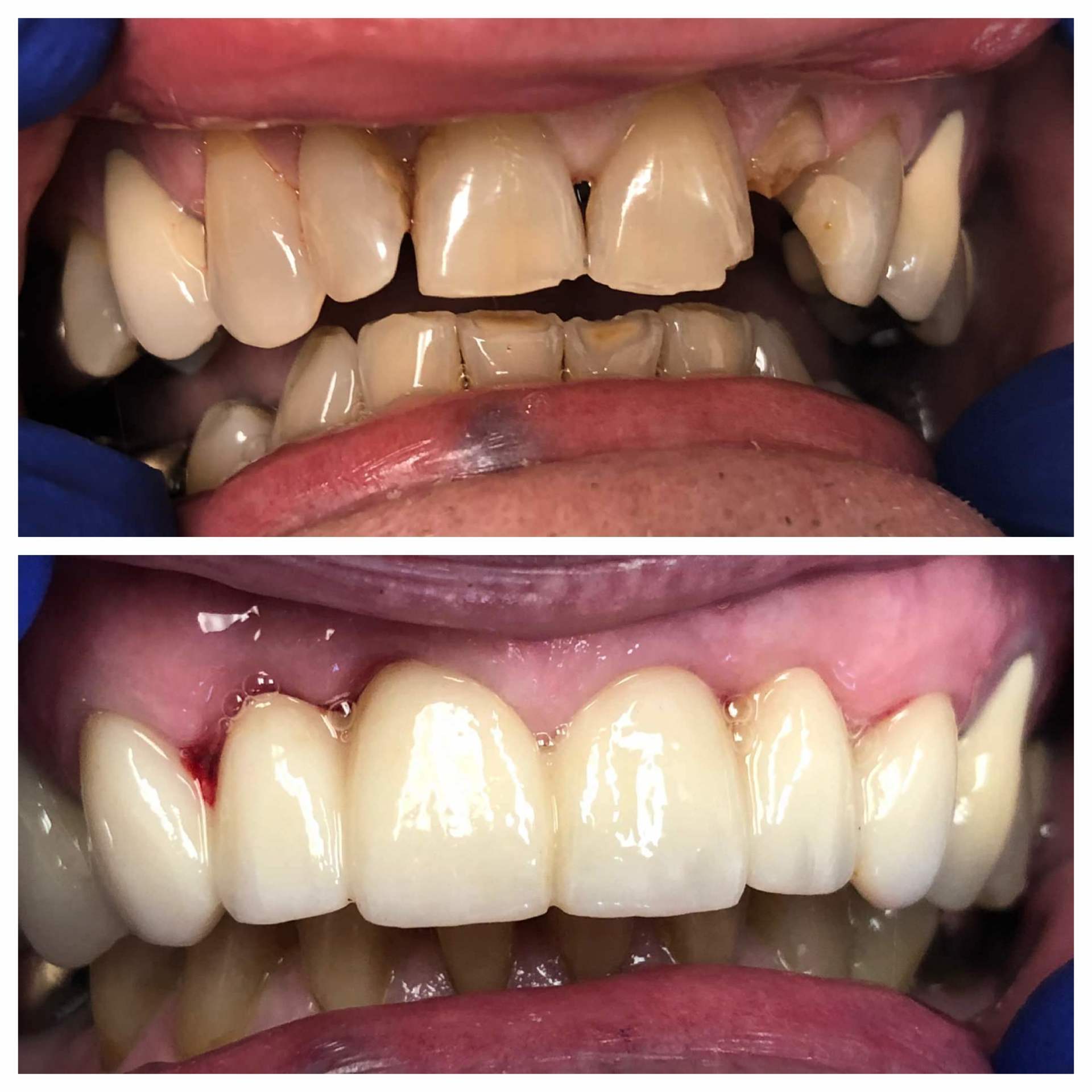 Teeth Veneer And Cleaning — Florence, AL — Johnson & Mahan Dental Care