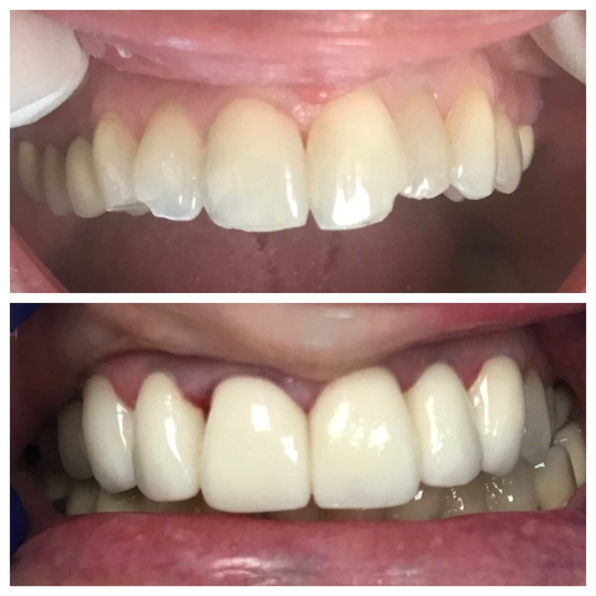 Before And After Dental Care — Florence, AL — Johnson & Mahan Dental Care