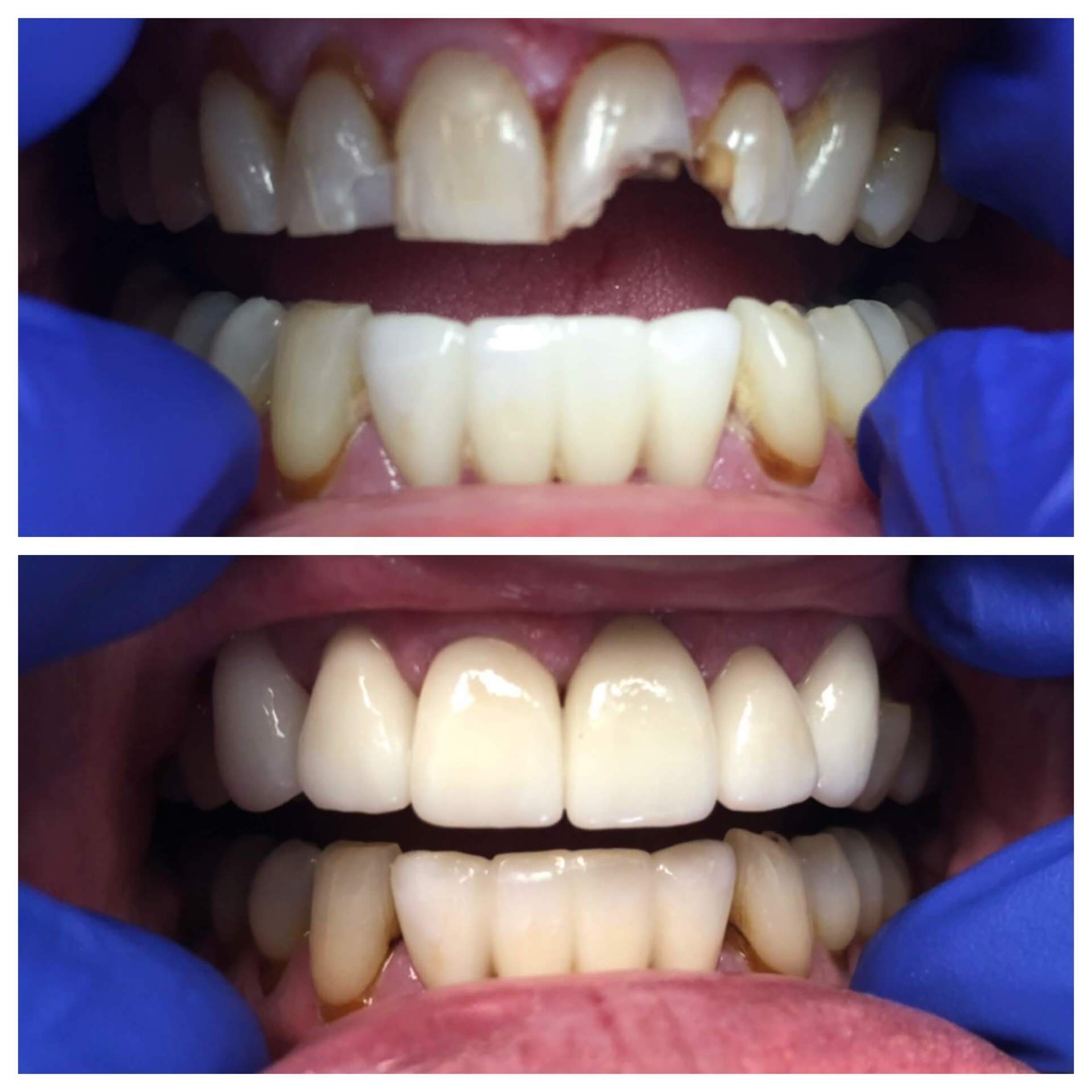 Before And After Veneer Treatment — Florence, AL — Johnson & Mahan Dental Care