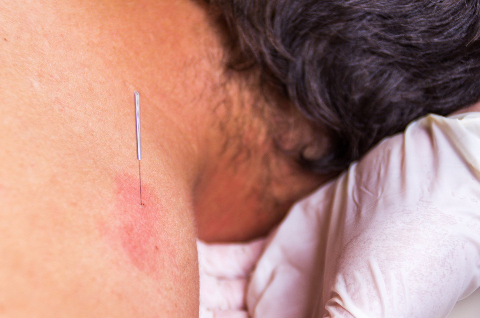 Person receiving dry needling therapy — Dry Needling in Mackay, QLD