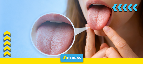 xerostomia, boca seca, saúde bucal, dentista, DNTBRAS