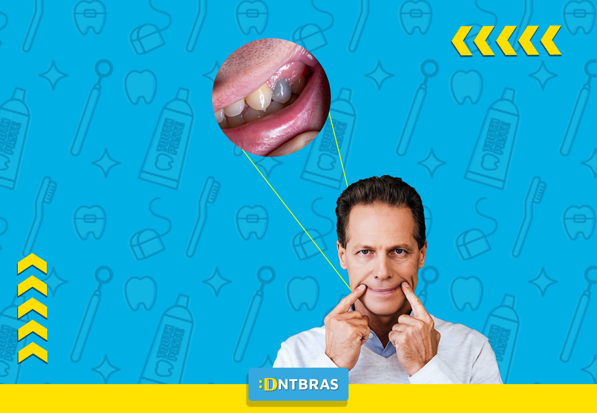Dente escurecido; odontologia
