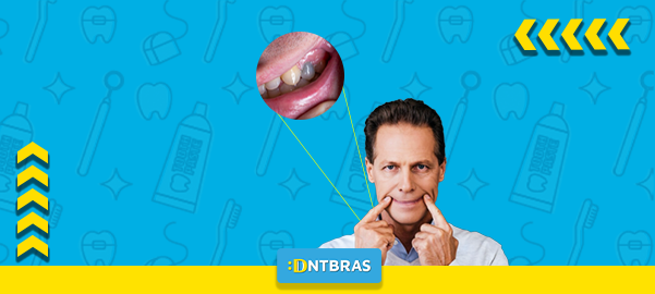 Dentes escurecidos; odontologia; saúde bucal